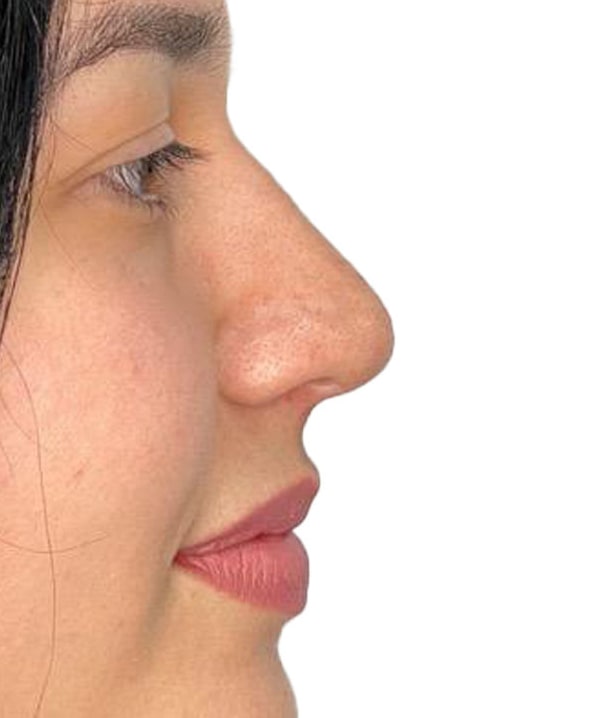 Nosereshaping After